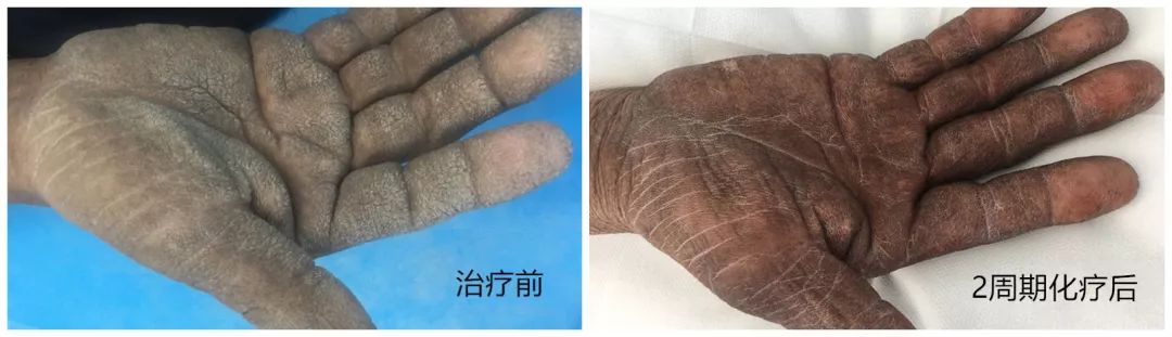 我院收治一例罕见黑棘皮病患者