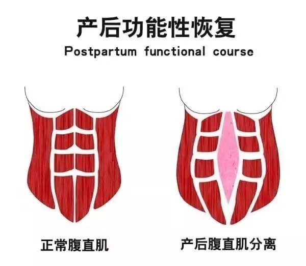 腹直肌分离的6大危害你知道吗