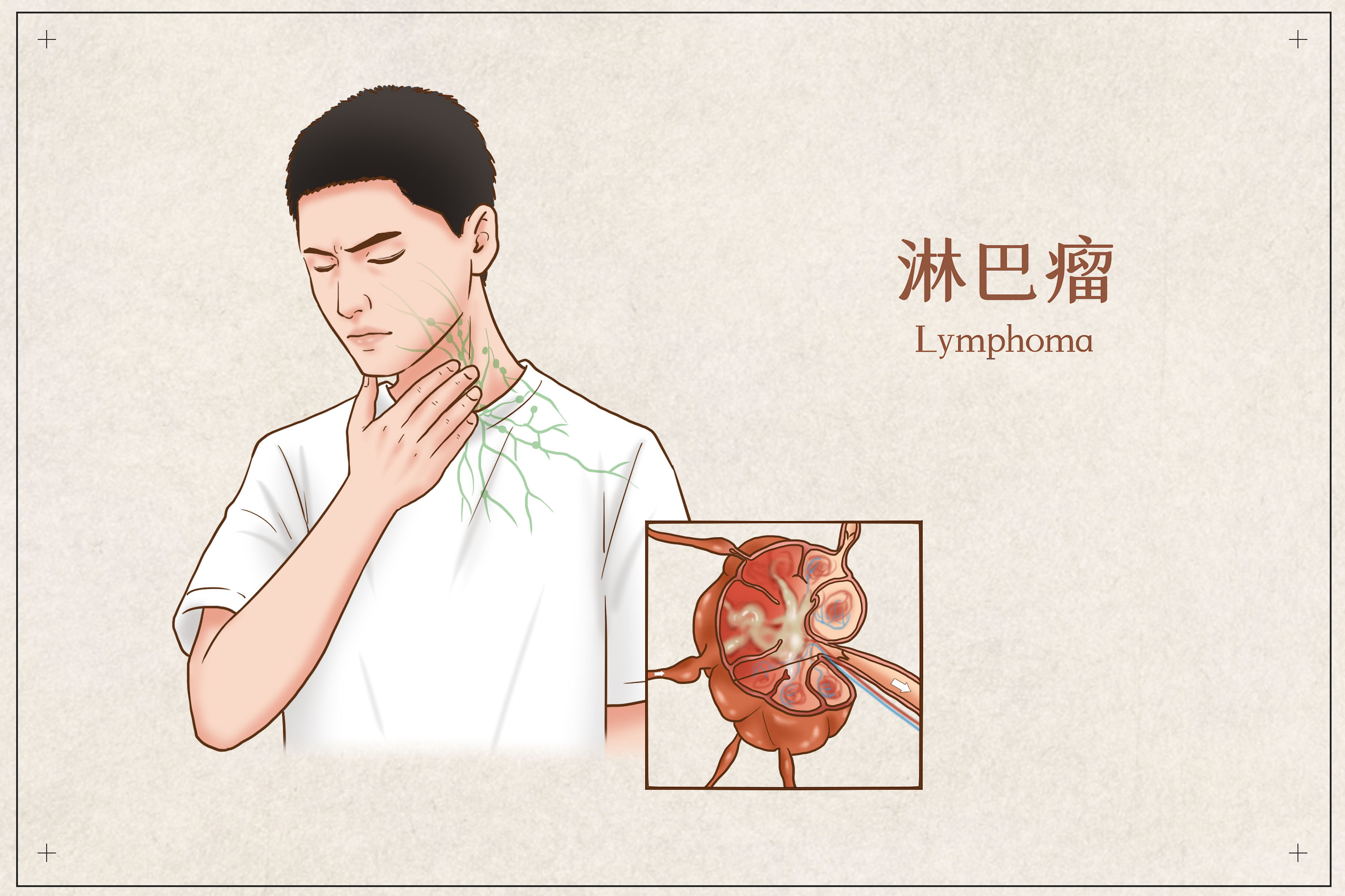 4.颈淋巴结清扫-外科主治医师-医学