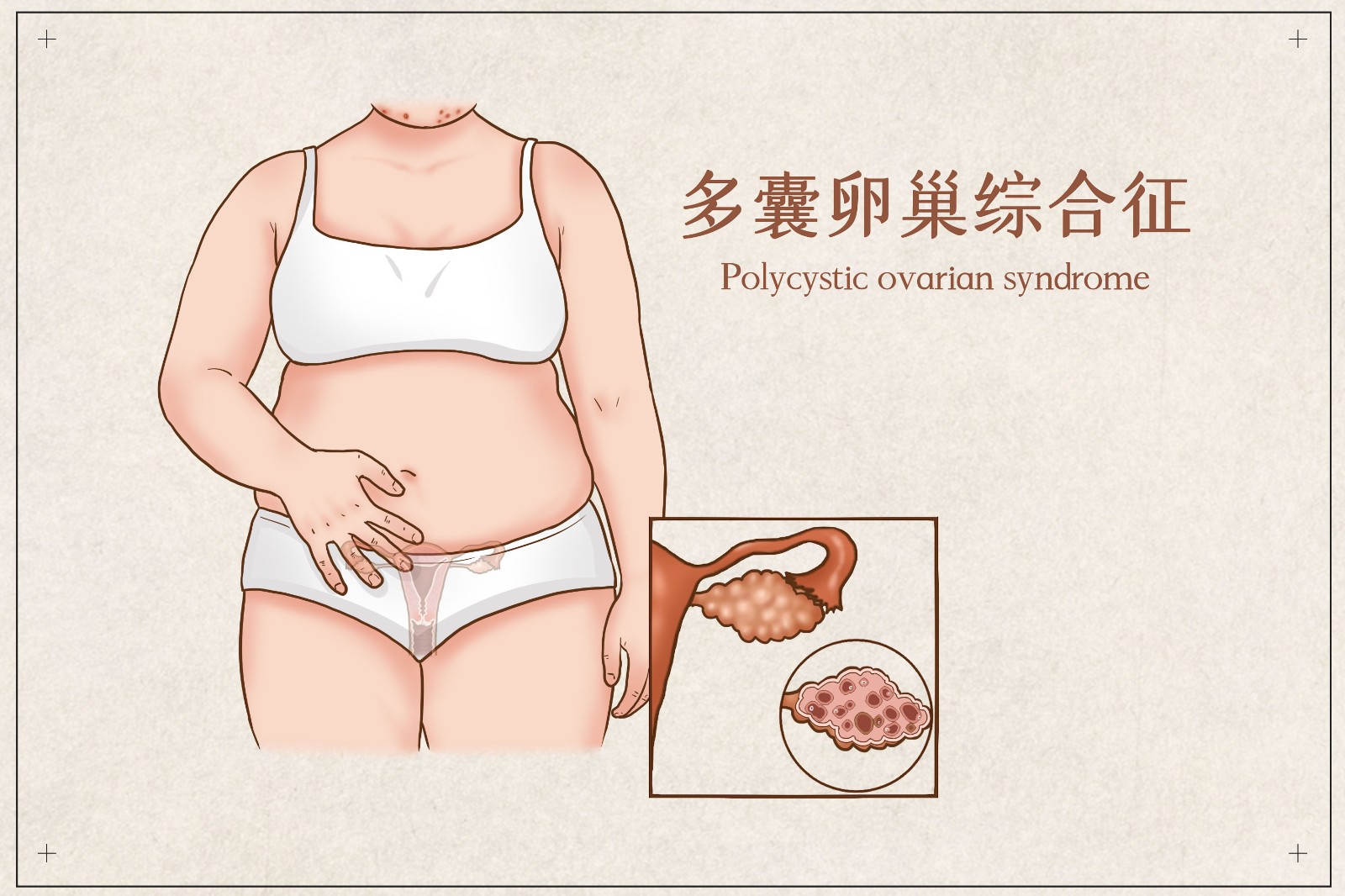 摄图网_401800160_多囊卵巢综合征医疗插画(企业商用).jpg